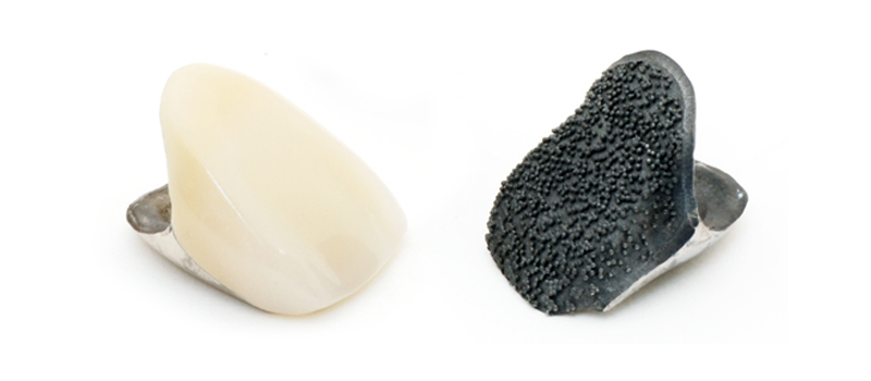 レジン前装、レジン前装チタン冠、保険、保険レジン前装冠